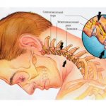 Межреберная невралгия
