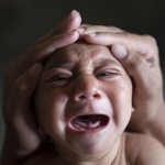 Микроцефалия