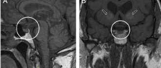 МРТ гипофиза с контрастом и без