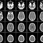 МРТ головного мозга