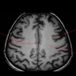 МРТ головного мозга