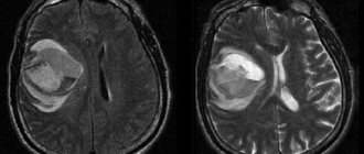 МРТ при сотрясении