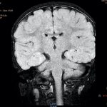 мрт рис. 2 а парагиппокампальная область