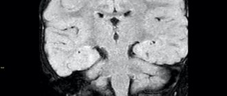 mri pic. 2 a parahippocampal area