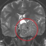МРТ турецкого седла что показывает