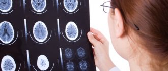 External hydrocephalus of the brain in an adult