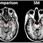Неинвазивная амигдатотомия на сканах мозга. Красным обведена зона миндалевидного тела, которая атрофируется у пациентов с болезнью Урбаха — Вите. Слева — норма, справа — пациентка С.М.