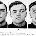 Неврит лицевого нерва