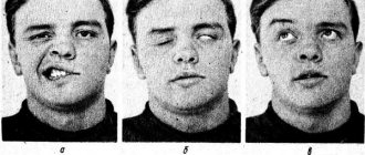 Facial neuritis