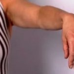 Неврит лучевого нерва: причины, симптомы, диагностика, лечение