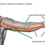 Неврит плечевого нерва: что это такое?