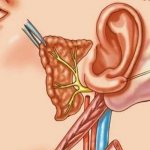 Неврит слухового нерва