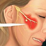 Неврит тройничного нерва