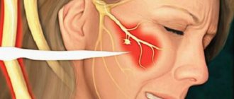 Trigeminal neuritis