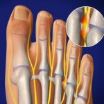 Неврома Мортона