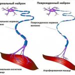 Normal and damaged neuron