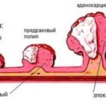 Новообразования на коже