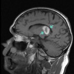 The focus of ischemia and necrosis of the brain (shown by arrows) on MRI