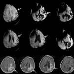 Todd&#39;s paralysis