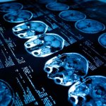 Почему происходит эпилептический припадок: причины и предвестники эпилепсии