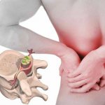 положительный симптом ласега