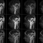 Layer-by-layer images during MRI angiography of cerebral vessels