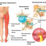 При защемлении седалищного нерва боль распространяется на всю ногу