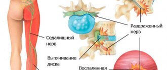 При защемлении седалищного нерва боль распространяется на всю ногу