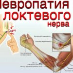 Причины невропатии локтевого нерва