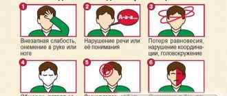 Признаки инсульта