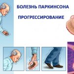 прогрессирование паркинсона