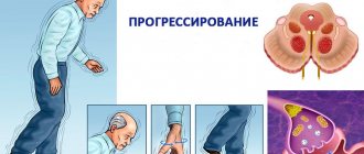 прогрессирование паркинсона