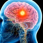 Психоорганический синдром - Алкоклиник