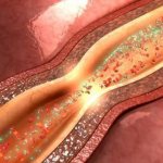 Пять способов снять спазмы сосудов без лекарств