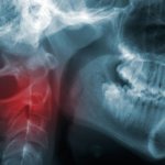 Рак головы и шеи