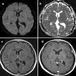 Rheumatoid meningitis with stroke-like abnormalities on MRI