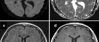Ревматоидный менингит с инсультоподобными нарушениями на МРТ