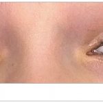 Рис. 1. Синдром Толоса – Ханта Fig. 1. Tolosa – Hunt syndrome