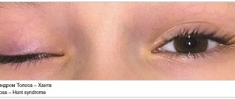 Рис. 1. Синдром Толоса – Ханта Fig. 1. Tolosa – Hunt syndrome