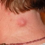 Сальная киста