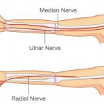 ulnar nerve compression