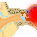 Схема локализации болезни Меньера