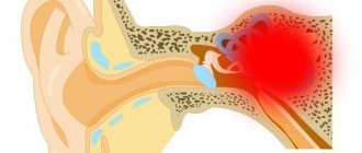 Схема локализации болезни Меньера