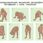 Ladder sign in Duchenne dystrophy