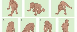 Симптом Лесенки при дистрофии Дюшенна