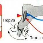 Симптом (рефлекс) Бабинского. Что это с двух сторон, справа, слева, положительный, отрицательный
