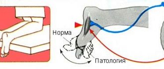Симптом (рефлекс) Бабинского. Что это с двух сторон, справа, слева, положительный, отрицательный