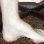 Симптомы атаксии Фридрейха