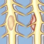 Симптомы опухолей в области спинного мозга