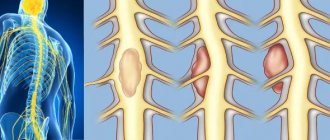 Symptoms of tumors in the spinal cord area